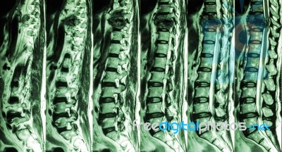 Mri Of Lumbar & Thoracic Spine : Show Fracture Of Thoracic Spine And Compress Spinal Cord ( Myelopathy ) Stock Photo