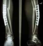 Fracture Shaft Of Tibia And Fibula Stock Photo