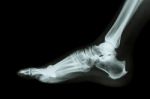 X-ray Normal Foot Lateral Stock Photo