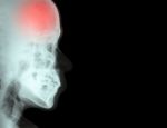 Stroke ( Cerebrovascular Accident ) ( Film X-ray Skull Lateral With Stroke ) And Blank Area At Right Side ( Medical And Science And Healthcare Background ) Stock Photo