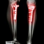 Fracture Tibia(leg Bone) Stock Photo