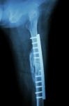 Fracture Shaft Of Femur. It Was Operated And Internal Fixation B Stock Photo