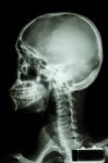 Human's Skull And Cervical Spine Stock Photo