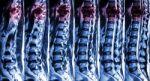 Mri Of Lumbar & Thoracic Spine : Show Fracture Of Thoracic Spine And Compress Spinal Cord ( Myelopathy ) Stock Photo