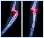 Fracture Elbow (left Image : Side Position , Right Image : Front Position) Stock Photo