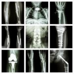 Collection Of Orthopedic Operation Stock Photo