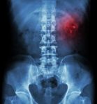 Kidney Stone ( Renal Stone , Renal Calculi ) ( Film X-ray Kub ( Kidney - Ureter - Bladder ) Show Left Renal Stone ) Stock Photo