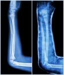 Fracture Shaft Of Ulnar Bone ( Forearm Bone )  : ( Left : Pre-treatment  ,  Right : Psot-treatment (splint With Cast) ) Stock Photo