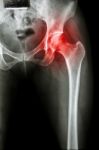 Arthritis At Hip Joint ( X-ray Pelvis & Hip Joint ) , ( Gout , Rheumatoid ) Stock Photo