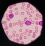 Blast Cells In Peripheral Blood Images Stock Photo