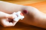 Cleaning Laceration Wound Stock Photo