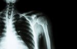 Fracture At Neck Of Humerus ( Arm Bone ) ( Film X-ray Left Shoulder And Blank Area At Right Side ) Stock Photo