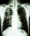 Pulmonary Tuberculosis Stock Photo