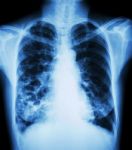 Bronchiectasis Stock Photo