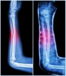 Fracture Shaft Of Ulnar Bone ( Forearm Bone )  : ( Left : Pre-treatment  ,  Right : Psot-treatment (splint With Cast) ) Stock Photo