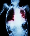 Pulmonary Tuberculosis With Acute Respiratory Failure ( Film Chest X-ray Of Old Patient Show Alveolar And Interstitial Infiltration Both Lung With Endotracheal Tube ) Due To Mycobacterium Tuberculosis Stock Photo