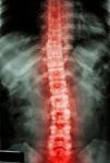 Film X-ray T-l Spine(thoracic-lumbar Spine) Show : Human's Thoracic-lumbar Spine And Inflammation At Spine Stock Photo