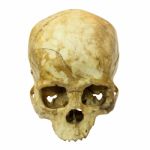 Human Skull Fracture(top Side,apex)(mongoloid,asian) On Isolated Stock Photo