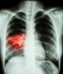 Pneumonia ( Film Chest X-ray Show Alveolar Infiltrate At Right Middle Lung ) ( Image For Pulmonary Tuberculosis , Mers-cov , Sars ) Stock Photo