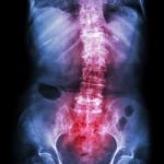 Spondylosis And Scoliosis ( Film X-ray Lumbar - Sacrum Spine Show Crooked Spine ) ( Old Patient ) ( Spine Healthcare ) Stock Photo