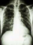 Pulmonary Tuberculosis Stock Photo