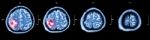 Brain Tumor  ( Film Ct-scan Of Brain : Show Part Of Brain With Tumor ) Stock Photo