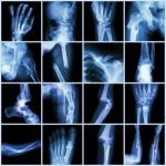 Collection X-ray Multiple Bone Fracture (finger,spine,wrist,hip,leg,clavicle,ankle,elbow,arm,foot) Stock Photo