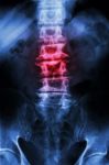 "spondylosis"  Film X-ray L-s Spine (lumbar-sacrum) Of Old Aged Patient And Inflammation At Spine Stock Photo