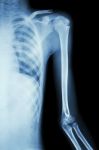 Film X-ray Left Shoulder Stock Photo