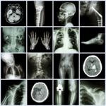 Set Of X-ray Multiple Part Of Human,multiple Disease,orthopedic,surgery (stroke,bone Fracture,orthopedic Operation,kidney Stone,arthritis,gout,pulmonary Tuberculosis,heart Disease,scoliosis,etc) Stock Photo