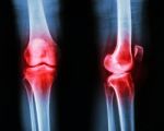 Film X-ray Knee Ap/lateral : Osteoarthritis Knee (inflammation At Knee) Stock Photo