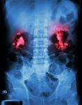 Bilateral Renal Calculi(staghorn) Stock Photo