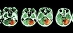 Stroke  ( Ct Scan Of Brain And Base Of Skull And Stroke ) Stock Photo