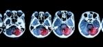 Stroke  ( Ct Scan Of Brain And Base Of Skull And Stroke ) Stock Photo