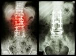 "spondylosis" (left Image) , Patient Was Operated And Internal Fixed. (right Image) Stock Photo