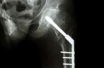 Fracture Neck Of Femur(thigh's Bone). Patient Was Operated And F Stock Photo