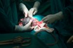 Cesarean Section Stock Photo