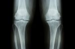 Osteoarthritis Knee ( Oa Knee ). Film X-ray Both Knee ( Front View ) Show Narrow Joint Space ( Joint Cartilage Loss ) , Osteophyte , Subchondral Sclerosis Stock Photo