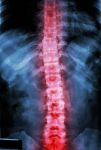 Film X-ray T-l Spine(thoracic-lumbar Spine) Show : Human's Thoracic-lumbar Spine And Inflammation At Spine Stock Photo