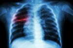 Pulmonary Tuberculosis ( Chest X-ray Of Child : Show Patchy Infiltration At Right Middle Lung ) Stock Photo