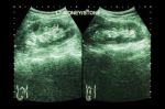 Ultrasonography Of Kidney : Show Left Kidney Stone ( 2 Image For Compare ) Stock Photo