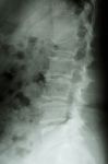 Film X-ray Lumbar Spine Lateral : Show Burst Fracture At Lumbar Stock Photo