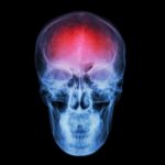 X-ray Skull And Stroke ( Cerebrovascular Accident (cva) ) Stock Photo