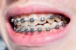 Mouth With Bracket Stock Photo