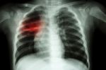 Pulmonary Tuberculosis ( Chest X-ray Of Child : Show Patchy Infiltration At Right Middle Lung ) Stock Photo