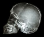 Film X-ray Skull Lateral : Show Normal Human's Skull (thai Peopl Stock Photo