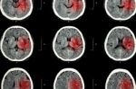 Ct Scan Of Brain With Red Area ( Imaging For Hemorrhagic Stroke Or Ischemic Stroke ( Infarction ) Concept ) Stock Photo