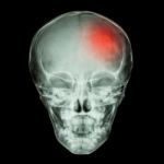 X-ray Skull Of Child And Stroke (cerebrovascular Accident) Stock Photo