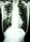 Mycobacterium Tuberculosis Infection (pulmonary Tuberculosis) Stock Photo