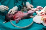 Cesarean Section Stock Photo